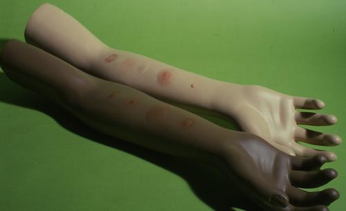 See-and-Touch Arms for TB Testing